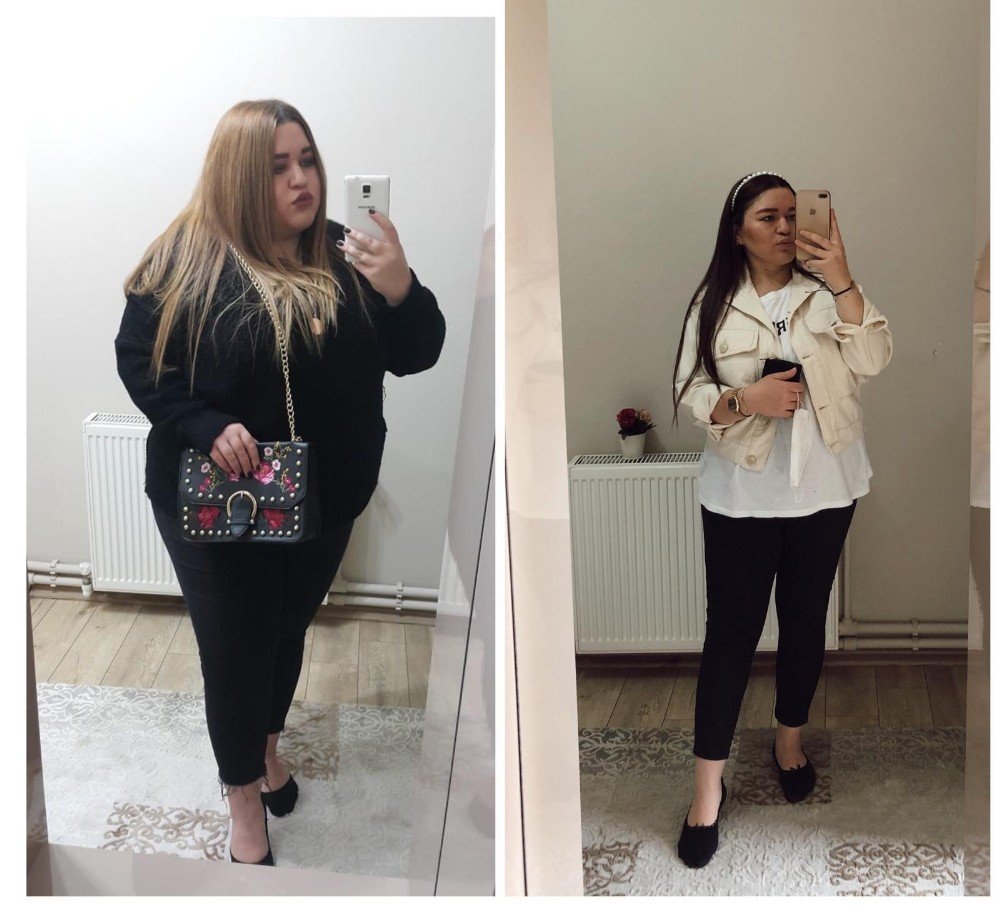 Mide Küçültme Ameliyatı İle 9 Ayda 58 Kilo Verdi