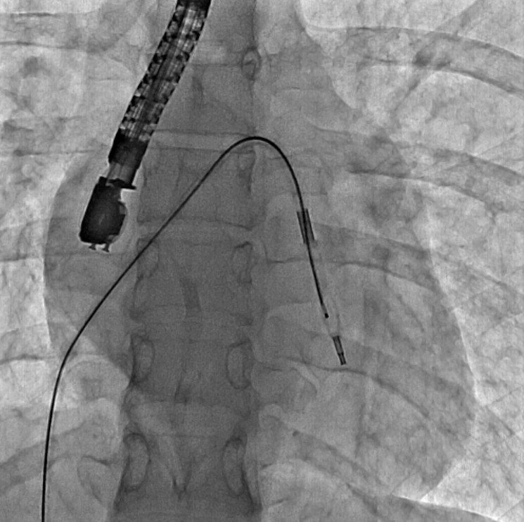 Mitral Balon Operasyonu Adım Adım Kaydedildi