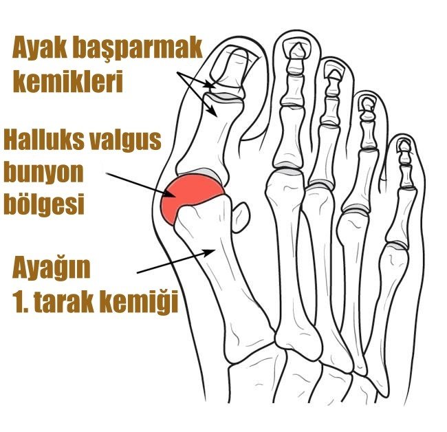 Dar Ve Sivri Burunlu Ayakkabılar Şekil Bozukluğuna Sebep Oluyor